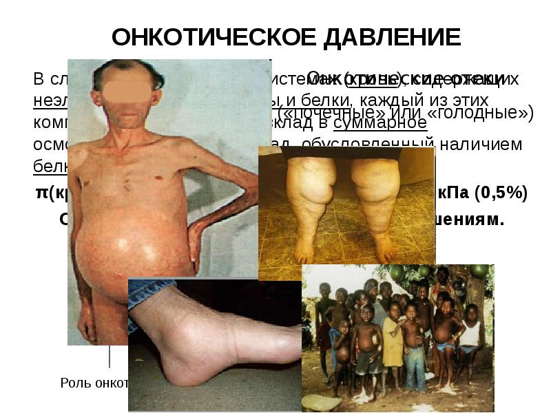 ОНКОТИЧЕСКОЕ ДАВЛЕНИЕ
В сложных биологических системах (кровь), содержащих неэлектролиты, электролиты и ОНКОТИЧЕСКОЕ ДАВЛЕНИЕ
В сложных биологических системах (кровь), содержащих неэлектролиты, электролиты и