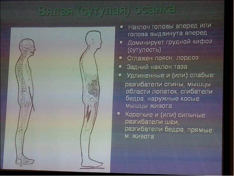 Выдвигает вперед. Шея выдвинута вперед. Голова выдвинута вперед. Спина выдвинута вперед. Наклон таза вперед и сутулость.