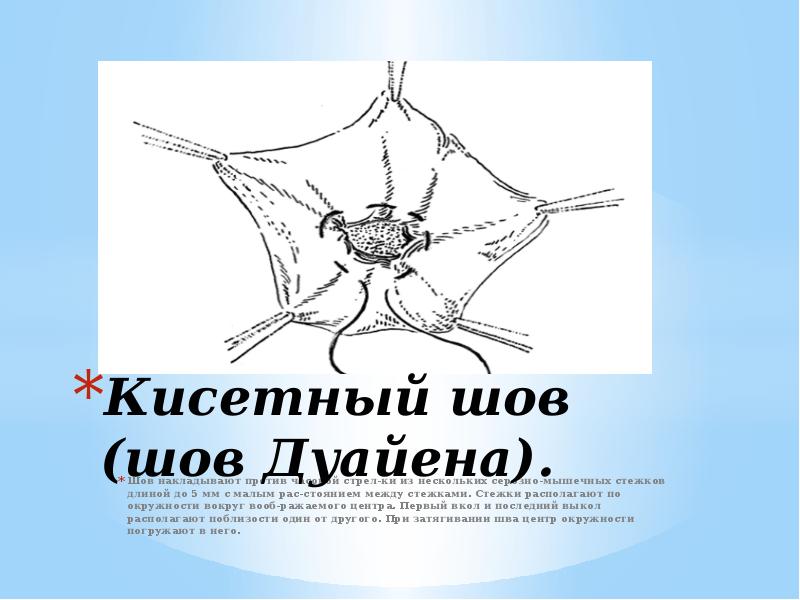 кисетный шов это. кисетный шов (шов дуайена). кисетный шов в ветеринарии. наложение кисетный шов. серозно-мышечный кисетный шов.