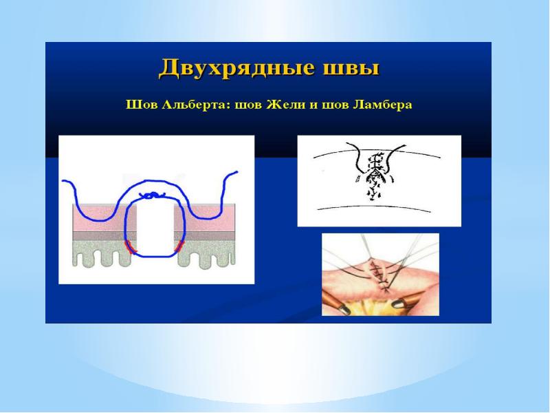 Кишечные швы топографическая анатомия презентация