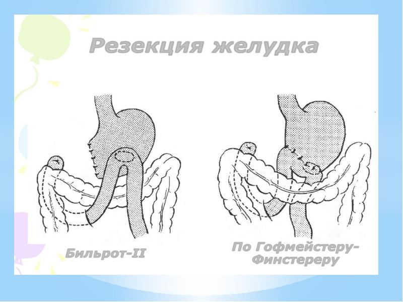 Бильрот 1 и 2 отличия схема