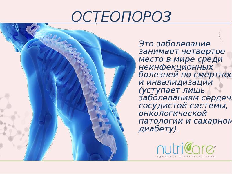Как лечить пала. Остеопороз. Остеопороз это заболевание. Профилактика остеопороза.