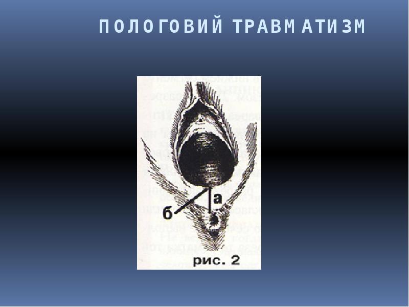 ПОЛОГОВИЙ ТРАВМАТИЗМ ПОЛОГОВИЙ ТРАВМАТИЗМ