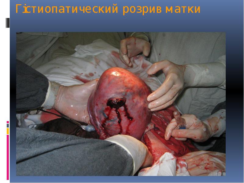 Гістиопатический розрив матки Гістиопатический розрив матки