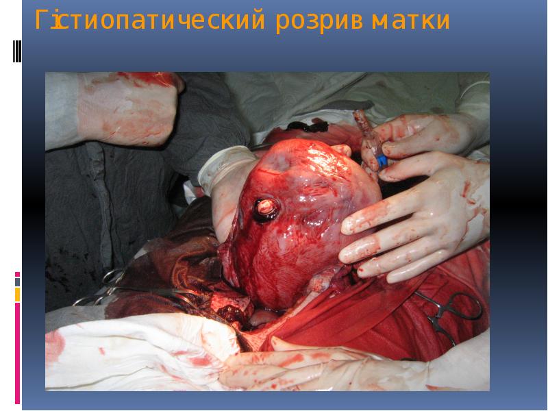 Гістиопатический розрив матки Гістиопатический розрив матки