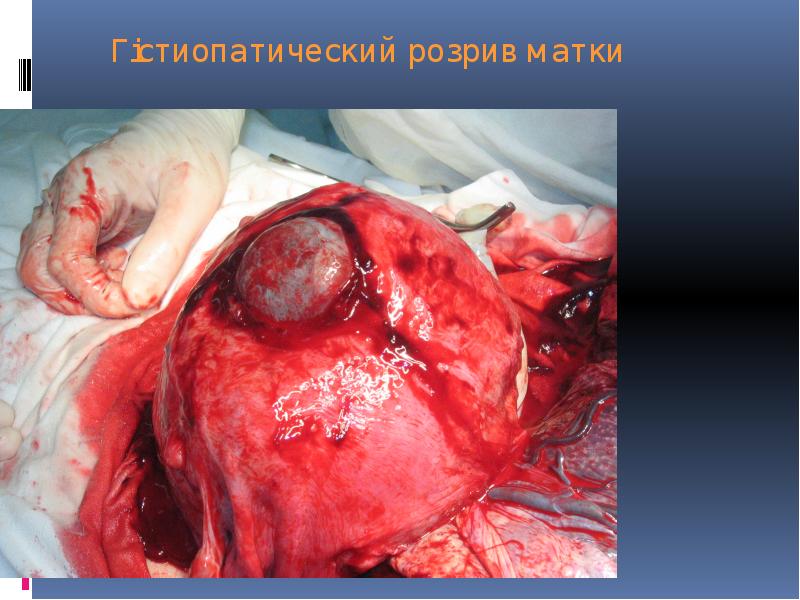 Гістиопатический розрив матки Гістиопатический розрив матки