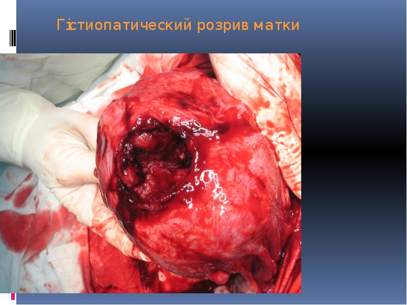 Гістиопатический розрив матки Гістиопатический розрив матки
