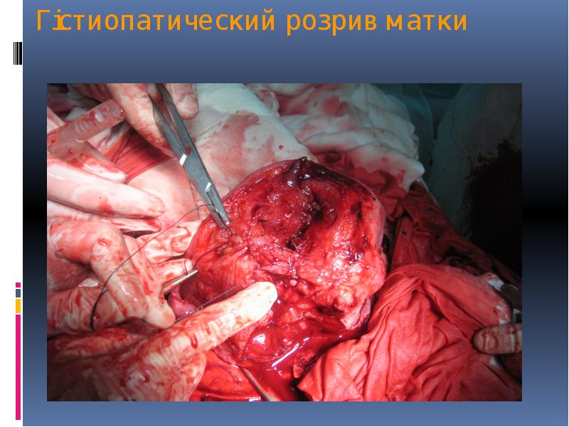 Гістиопатический розрив матки Гістиопатический розрив матки