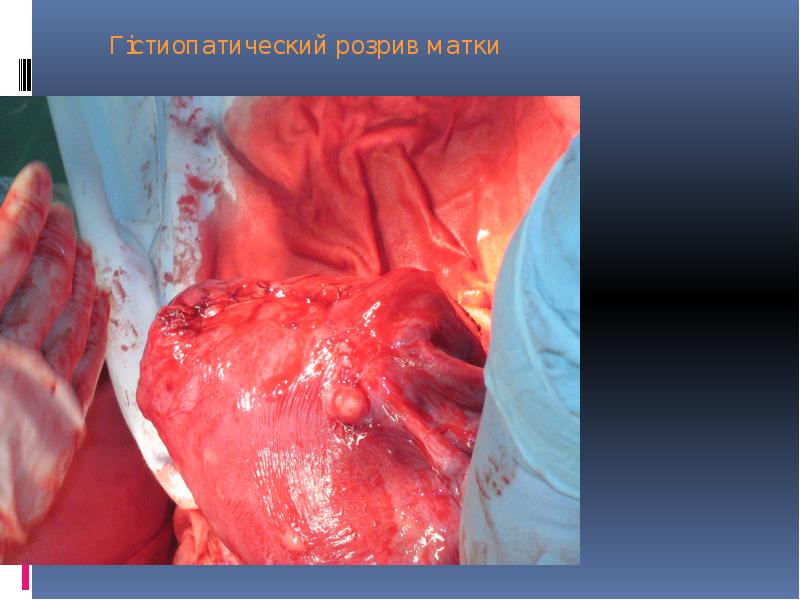 Гістиопатический розрив матки Гістиопатический розрив матки