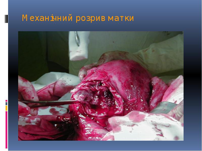 Механічний розрив матки Механічний розрив матки