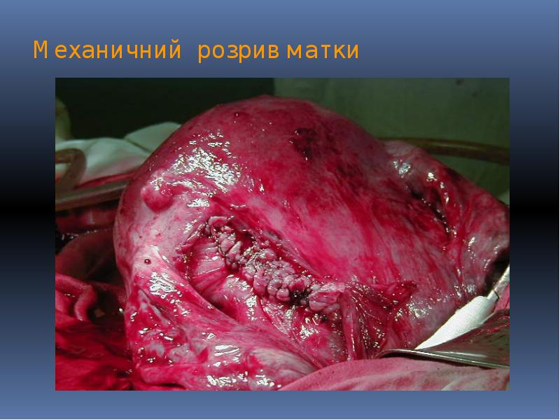 Механичний розрив матки Механичний розрив матки