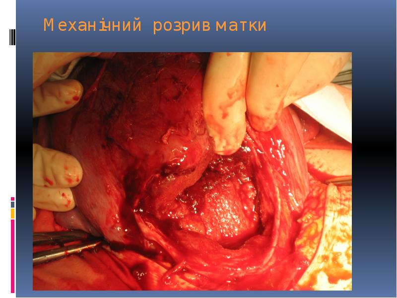 Механічний розрив матки Механічний розрив матки