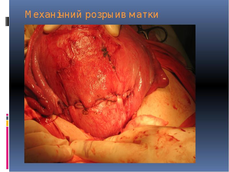 Механічний розрыив матки Механічний розрыив матки