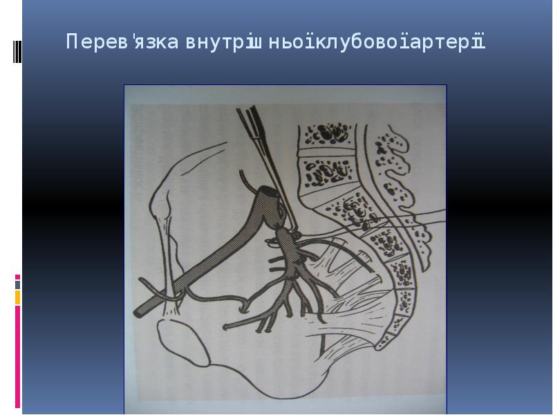Перев'язка внутрішньої клубової артерії Перев'язка внутрішньої клубової артерії