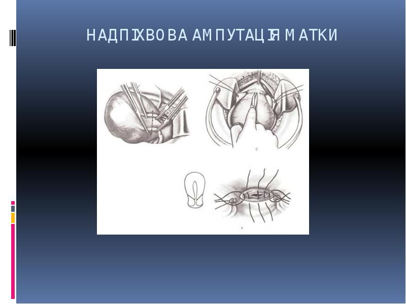 НАДПІХВОВА АМПУТАЦІЯ МАТКИ НАДПІХВОВА АМПУТАЦІЯ МАТКИ
