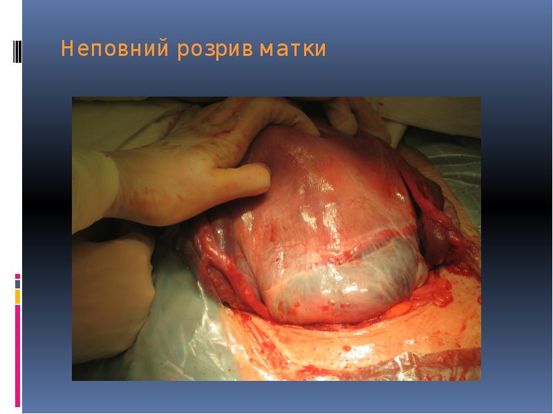 Неповний розрив матки Неповний розрив матки