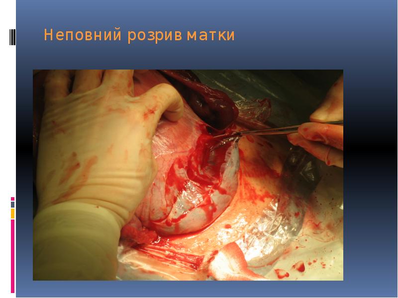 Неповний розрив матки Неповний розрив матки