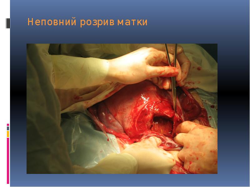 Неповний розрив матки Неповний розрив матки