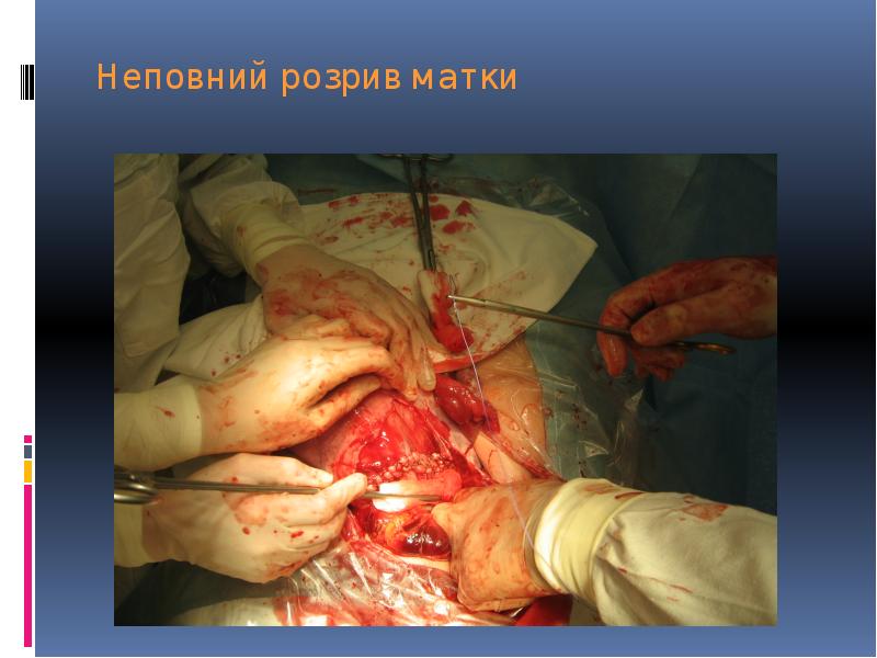 Неповний розрив матки Неповний розрив матки