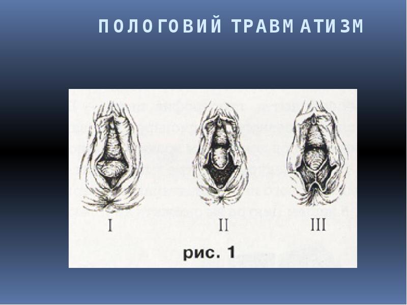 ПОЛОГОВИЙ ТРАВМАТИЗМ ПОЛОГОВИЙ ТРАВМАТИЗМ