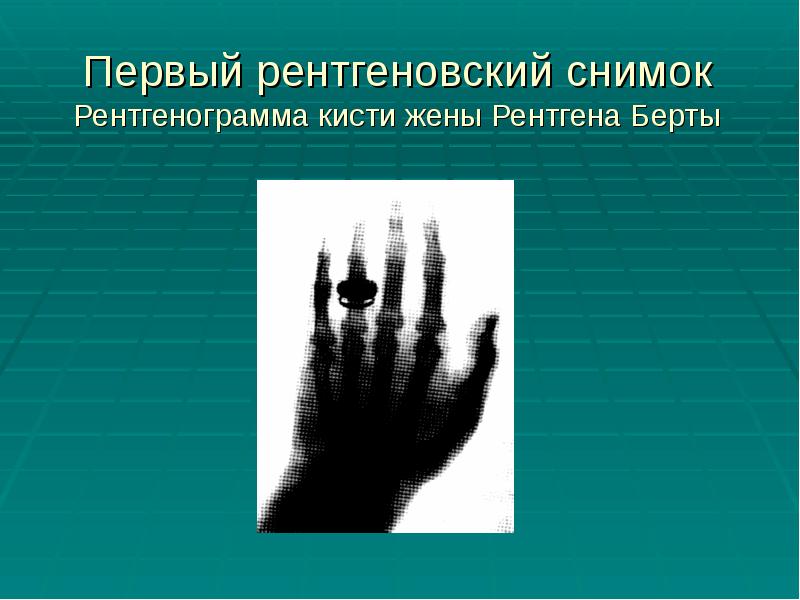 Первый рентгеновский снимок Рентгенограмма кисти жены Рентгена Берты Первый рентгеновский снимок Рентгенограмма кисти жены Рентгена Берты