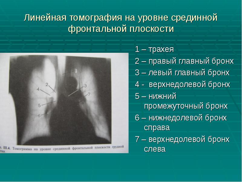 Линейная томография на уровне срединной фронтальной плоскости
1 – трахея
2 Линейная томография на уровне срединной фронтальной плоскости
1 – трахея
2