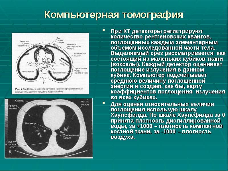 Компьютерная томография
При КТ детекторы регистрируют количество рентгеновских квантов, поглощенных каждым Компьютерная томография
При КТ детекторы регистрируют количество рентгеновских квантов, поглощенных каждым