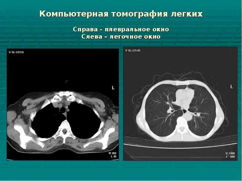 Компьютерная томография легких Справа - плевральное окно Слева – Компьютерная томография легких Справа - плевральное окно Слева –