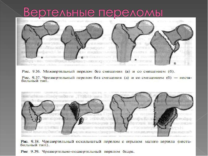 Травмы верхних и нижних конечностей презентация