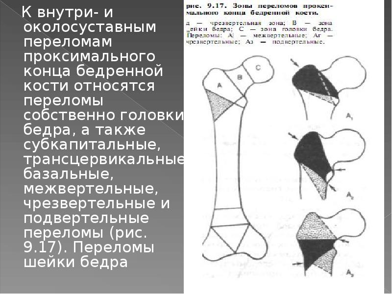 Переломы бедренной кости тесты нмо с ответами. Внесуставные переломы шейки бедра. Субкортикальный перелом головки бедренной кости. Проксимальный перелом шейки бедра. Перелом бедренной кости вертельной зоны классификация.