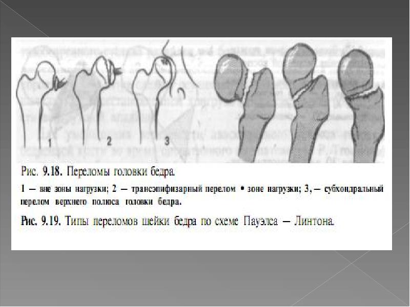 Травмы верхних и нижних конечностей презентация