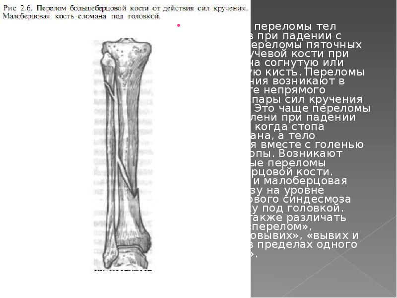 Диафизарные переломы костей голени презентация