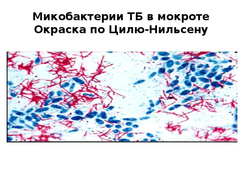 Микобактерии туберкулеза микроскопия мокроты. Микобактерии в мокроте. Микобактерии туберкулеза микроскопия по цилю нильсену. Микобактерии в мокроте. Микобактерии туберкулеза микроскопия.