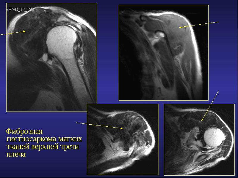 Фиброзные изменения тканей. Опухоль плечевого сустава.