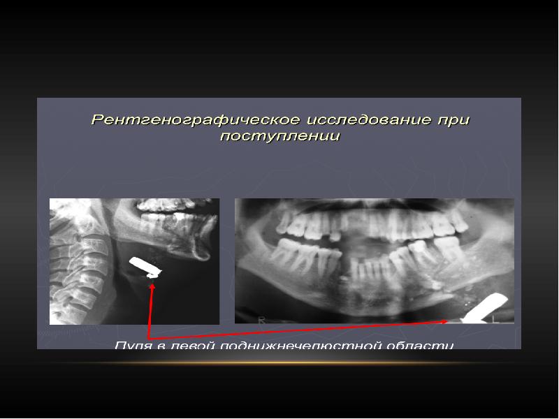 Комбинированные повреждения чло презентация