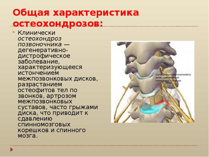 Остеохондроз картинки для презентации