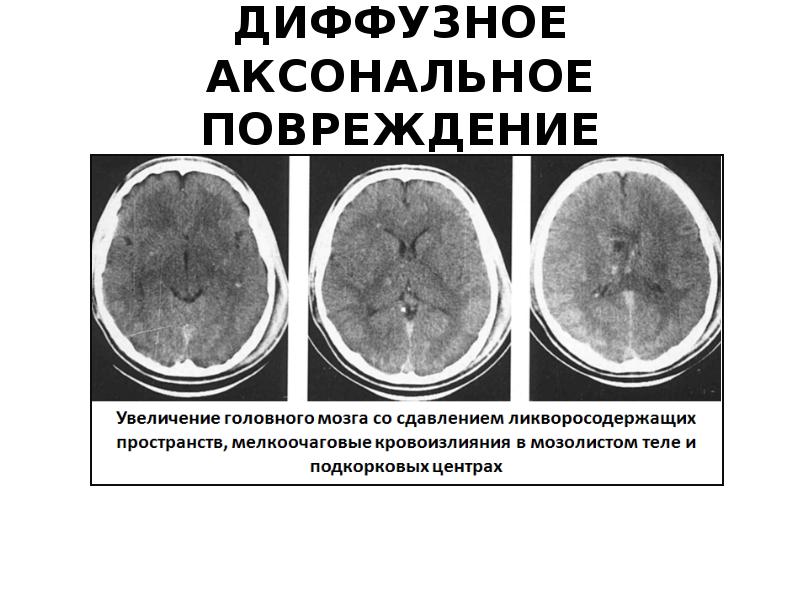 Диффузная травма головного. Аксональное повреждение головного. Ушиб головного мозга средней степени кт. Ушиб головного мозга легкой степени кт. Мрт сотрясение головного мозга снимок.