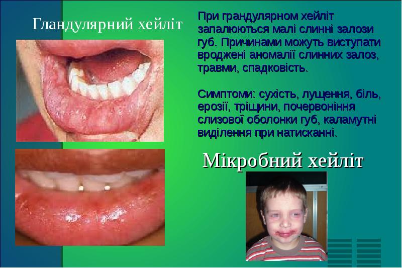 Мікробний хейліт