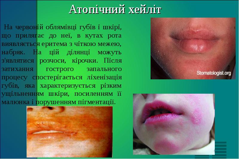 Атопічний хейліт