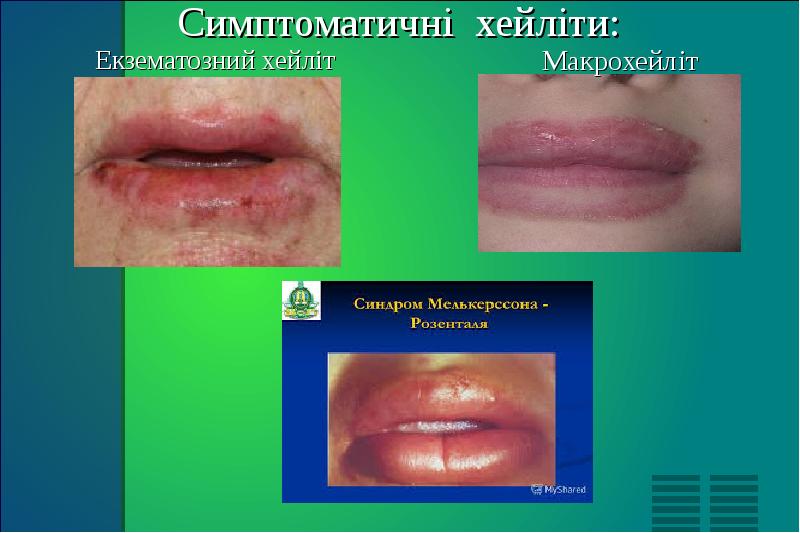 Симптоматичні хейліти: Екзематозний хейліт