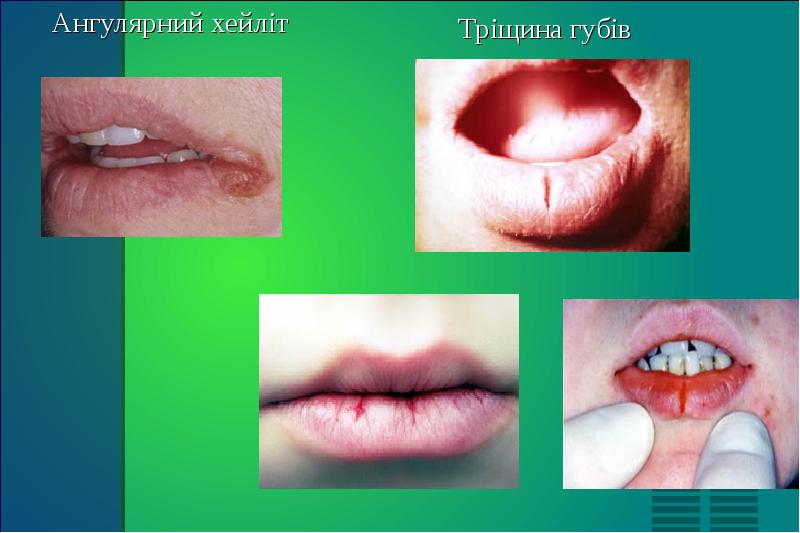 Ангулярний хейліт Тріщина губів