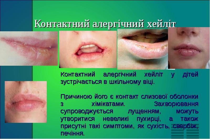 Контактний алергічний хейліт