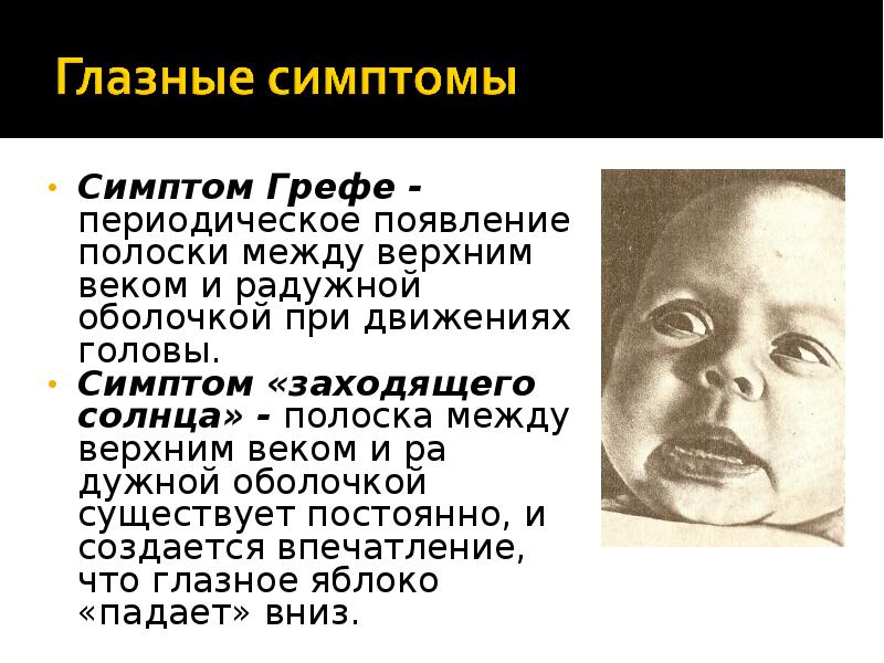 Синдром нервно рефлекторной возбудимости. Симптом заходящего солнца симптом Грефе. Симптом Грефе у новорожденных. Положительный симптом Грефе.