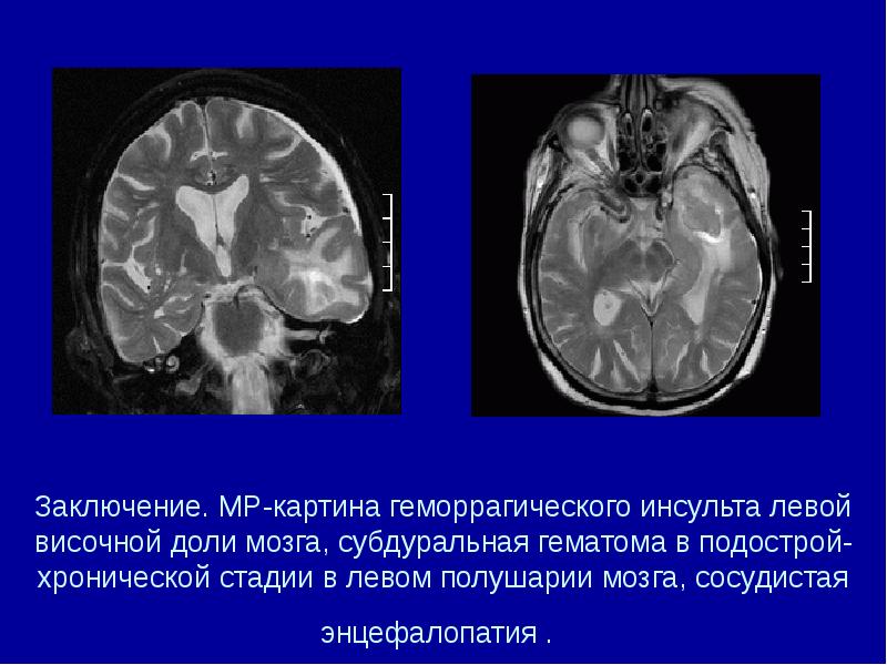 Заключение. МР-картина геморрагического инсульта левой височной доли мозга, субдуральная гематома в