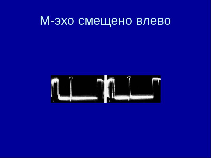 М-эхо смещено влево