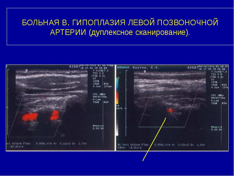 БОЛЬНАЯ В. ГИПОПЛАЗИЯ ЛЕВОЙ ПОЗВОНОЧНОЙ АРТЕРИИ (дуплексное сканирование).