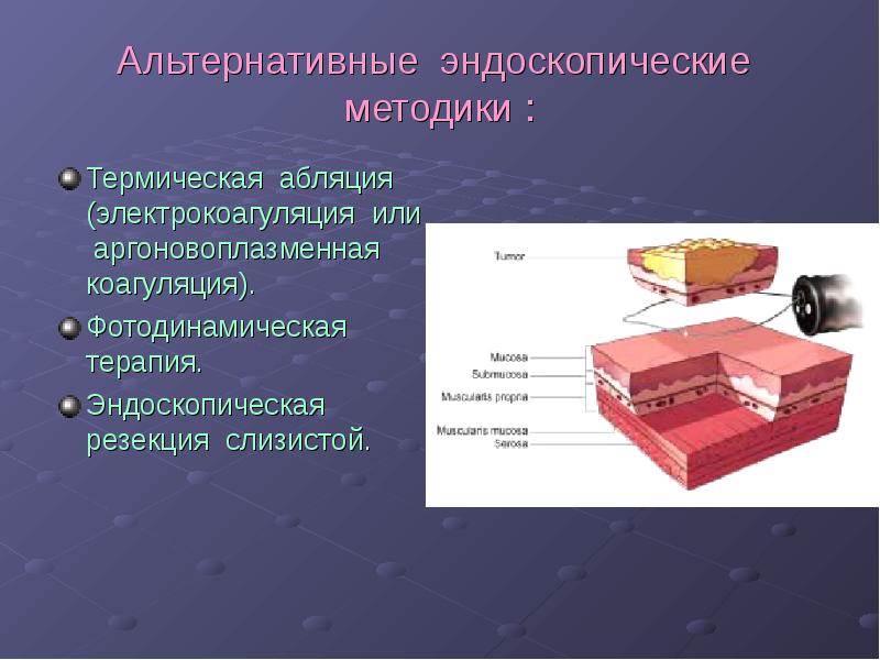 Пищевод барретта фото