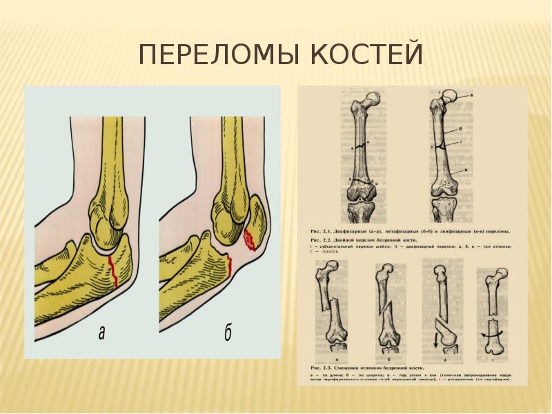 Перелом кости рисунок