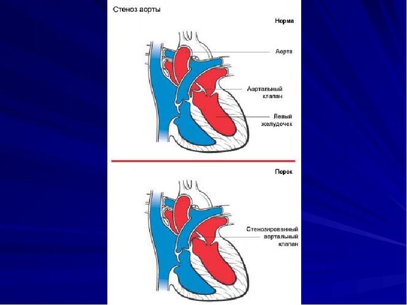 Стеноз устья аорты гемодинамика схема