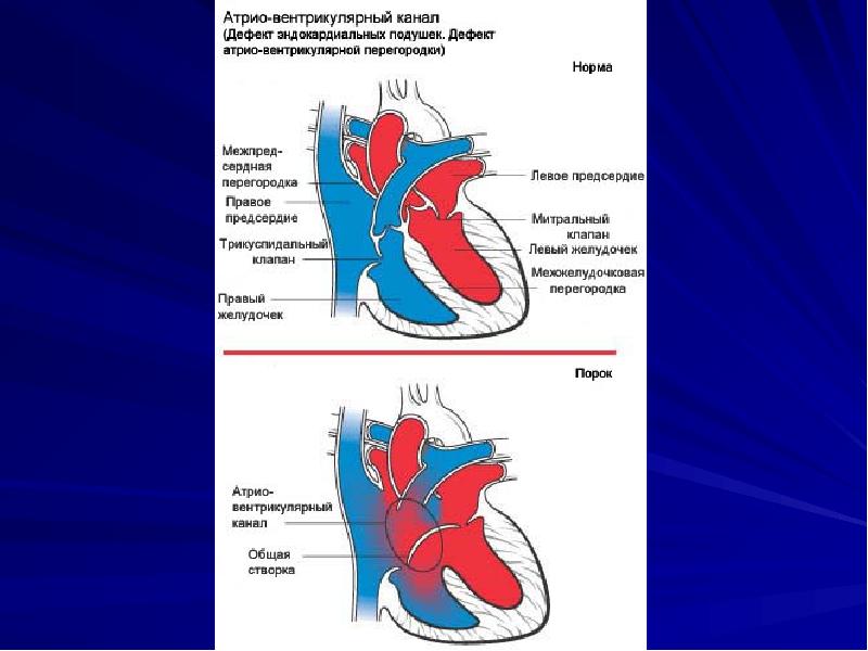 Открытый атриовентрикулярный канал презентация